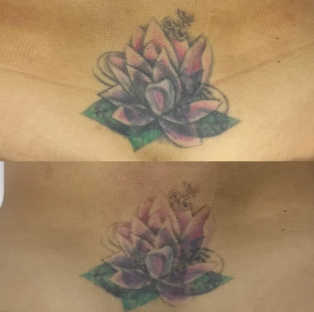 professional tattoo removal