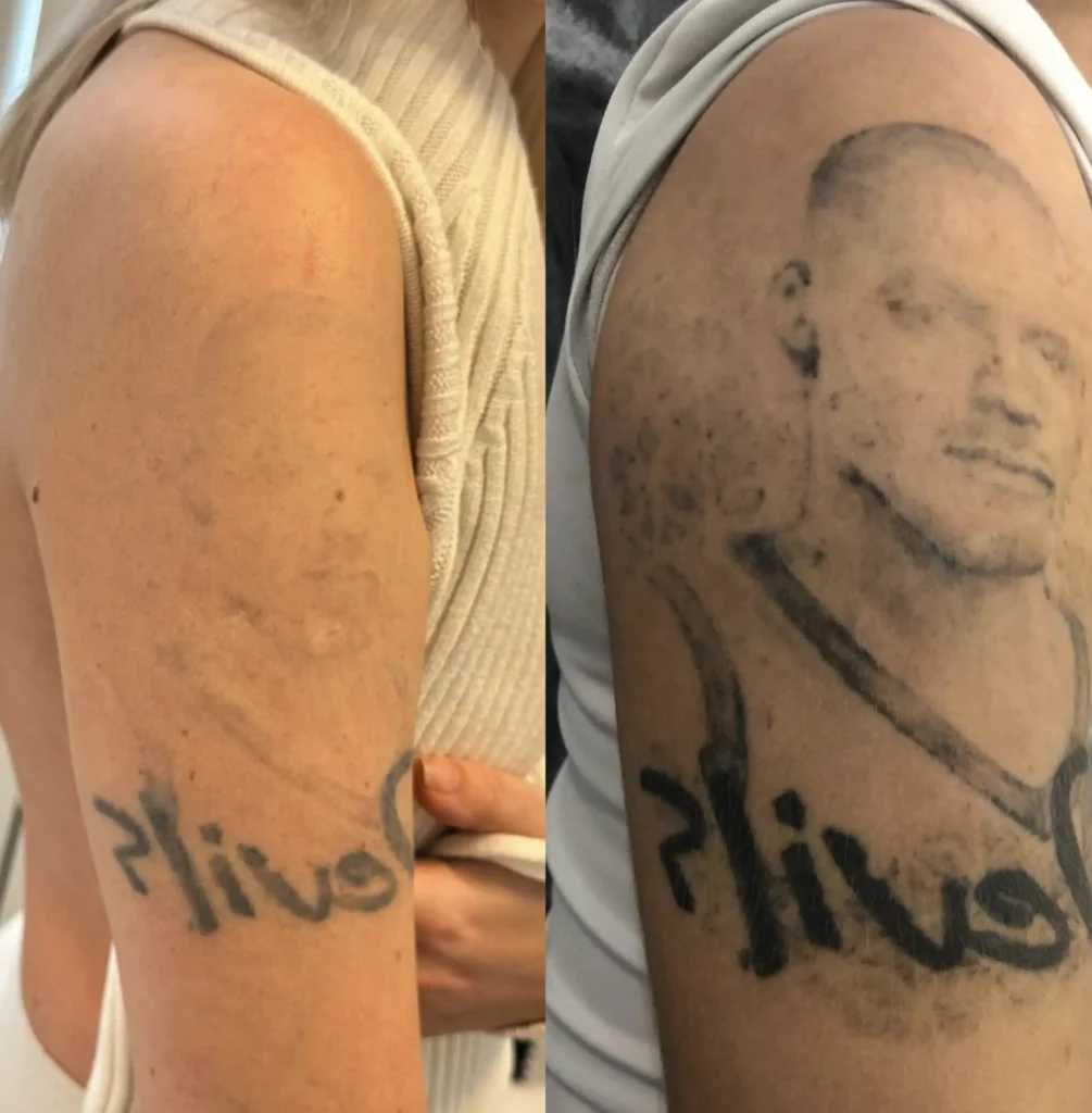 tattoo laser removal