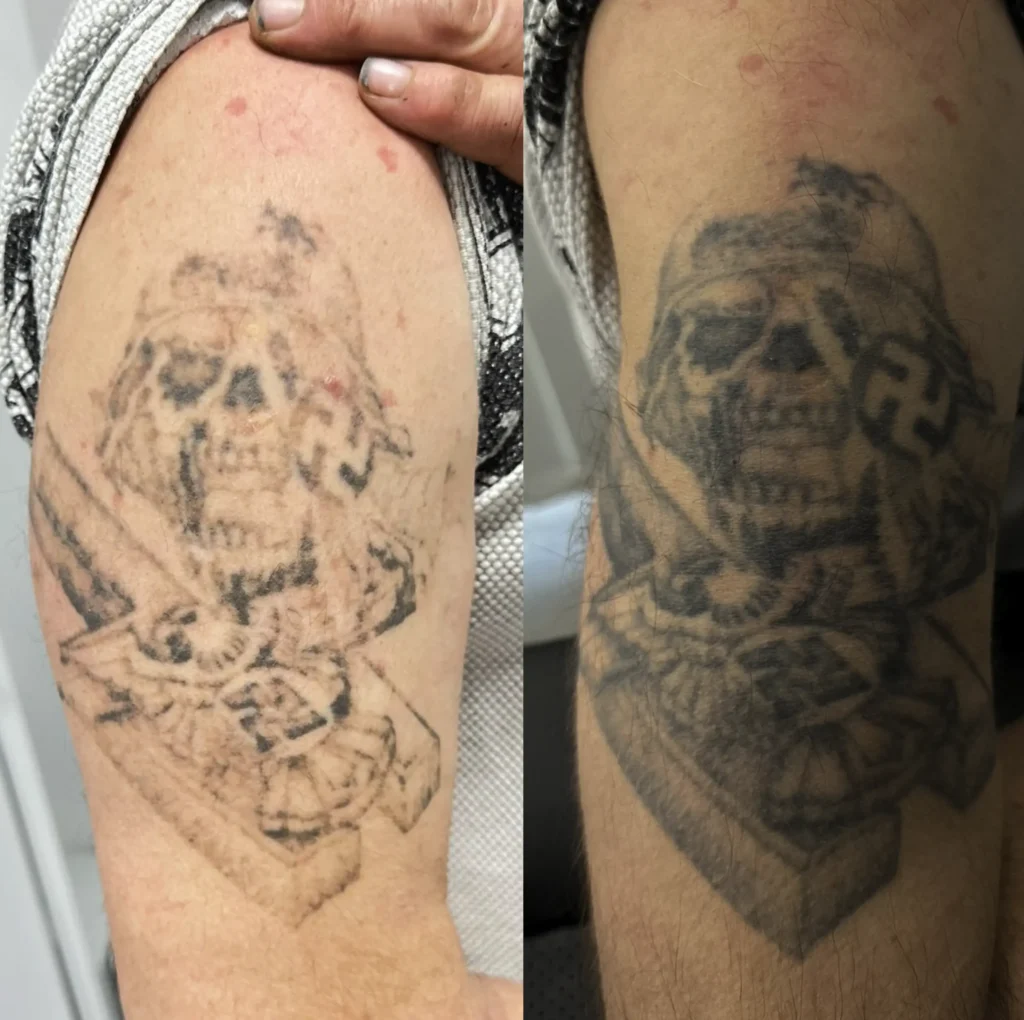 tattoo remove laser